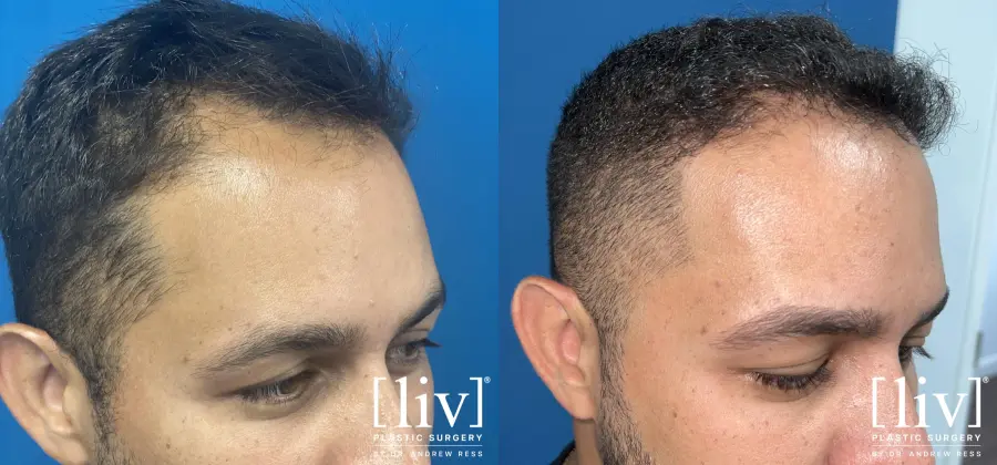 FUE Hair Transplant - Before and After 3