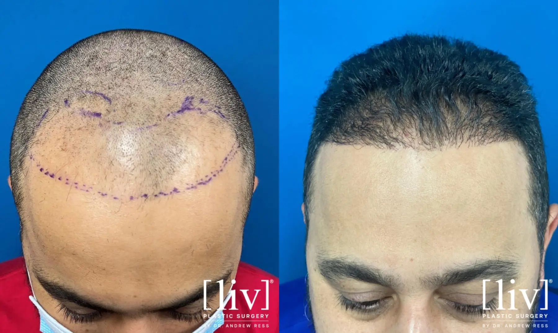 FUE Hair Transplant - Before and After 1