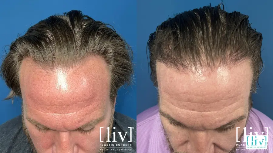 Hair Transplantation: Patient 2 - Before and After 1