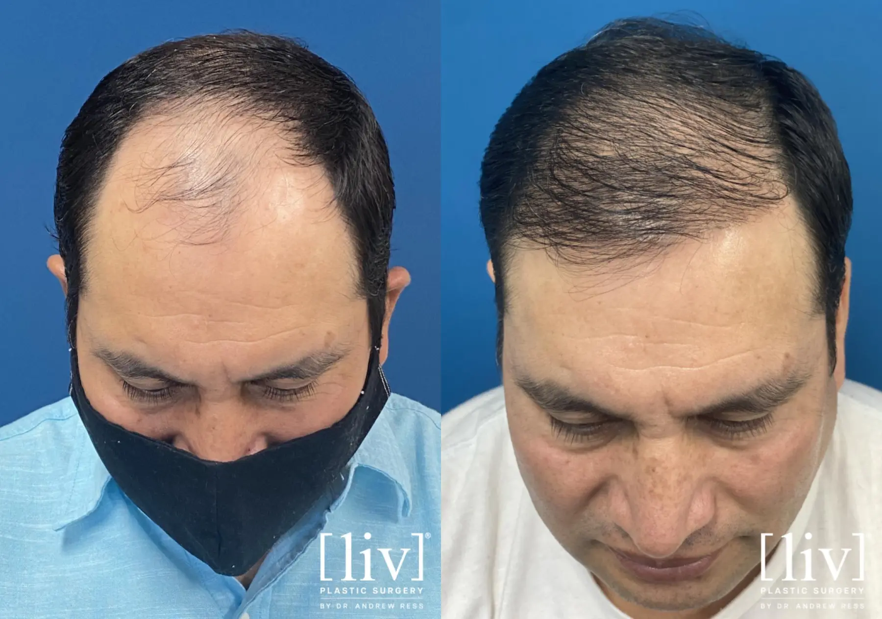 Hair Transplantation: Patient 1 - Before and After  