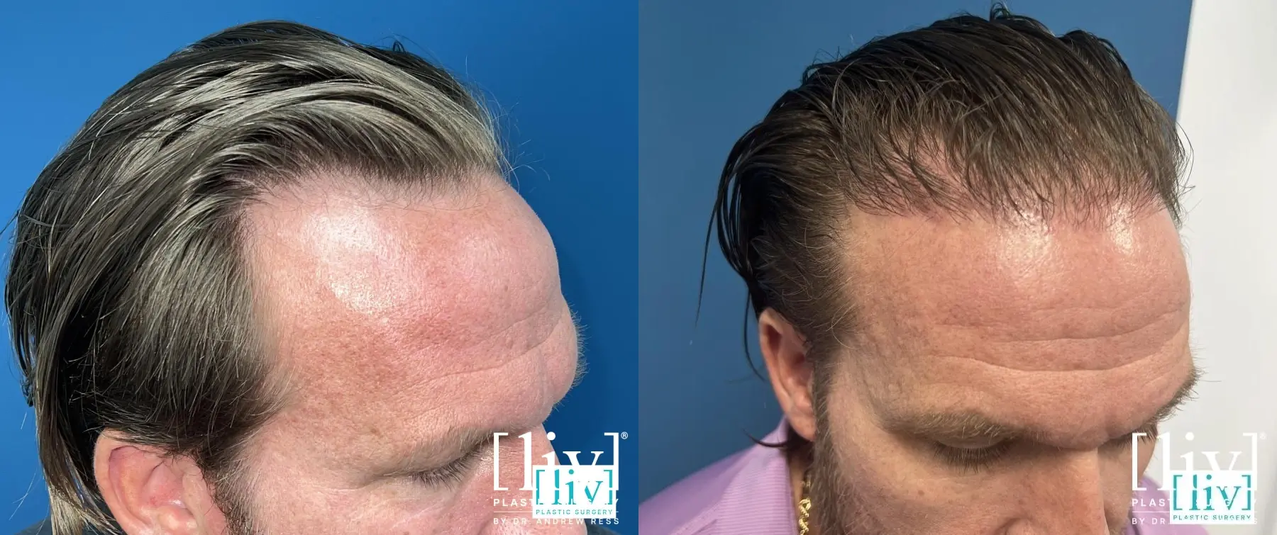 FUE Hair Transplant - Before and After 2