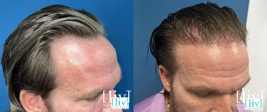 Hair Transplantation: Patient 2 - Before and After 2