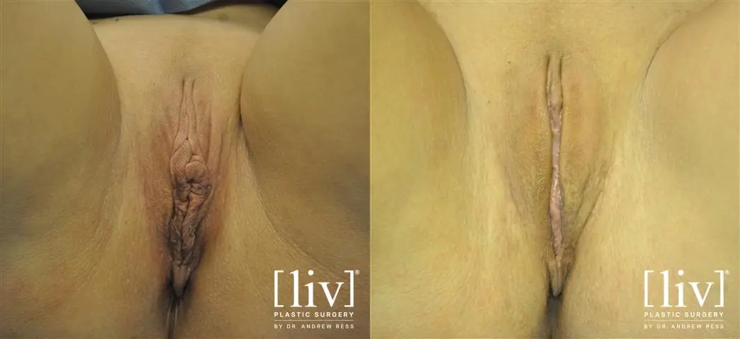 Labiaplasty: Patient 1 - Before and After  