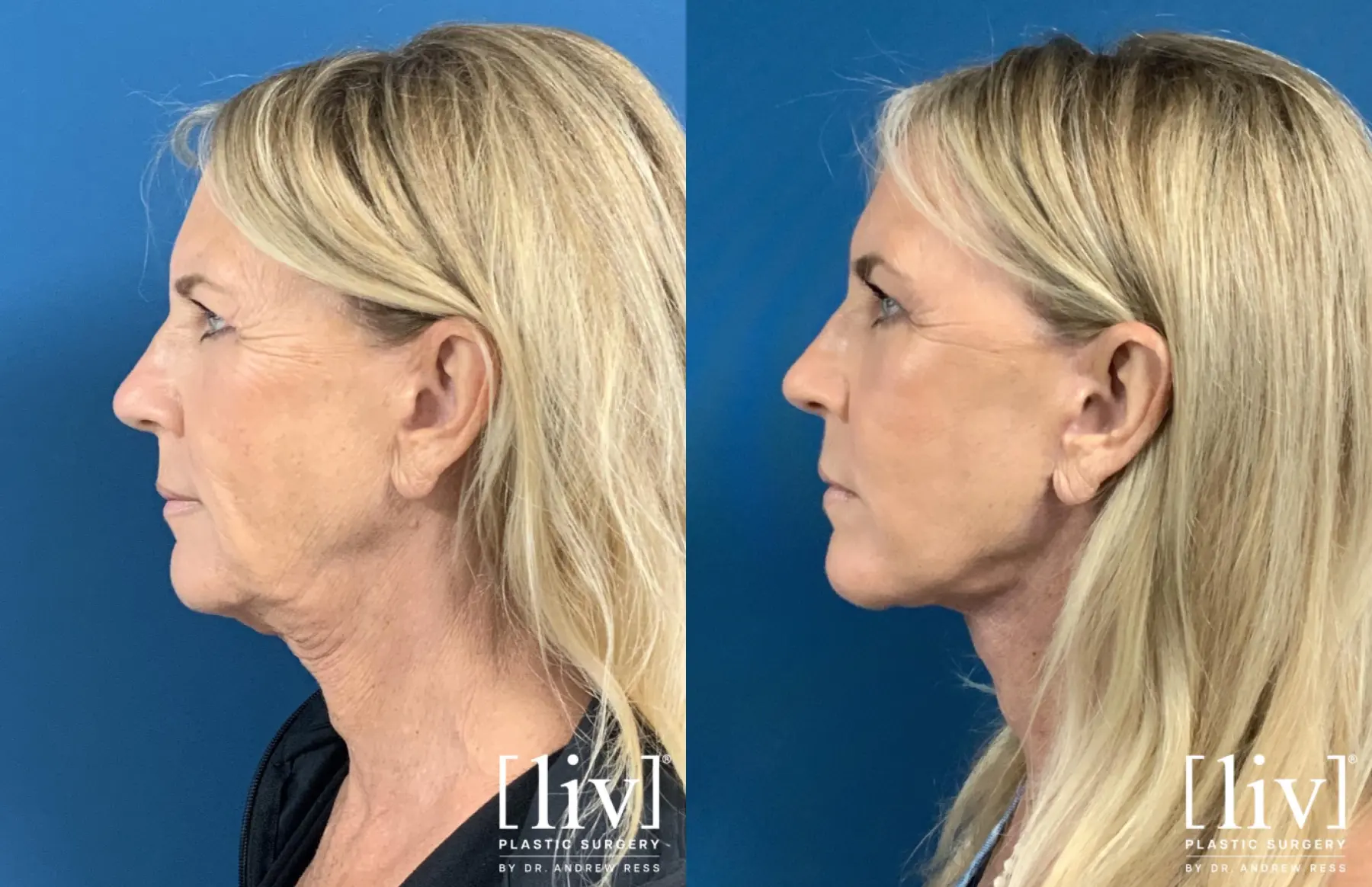 Face and Neck Lift with CO2 Laser - Before and After 3
