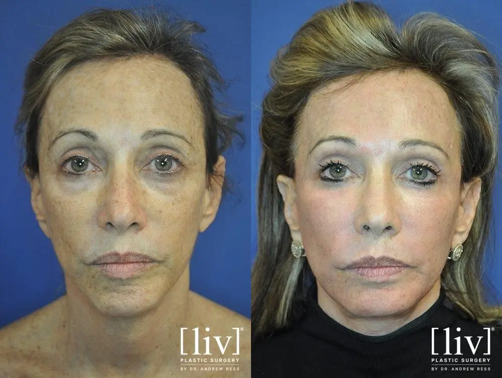 Laser Skin Resurfacing: Patient 1 - Before and After 1