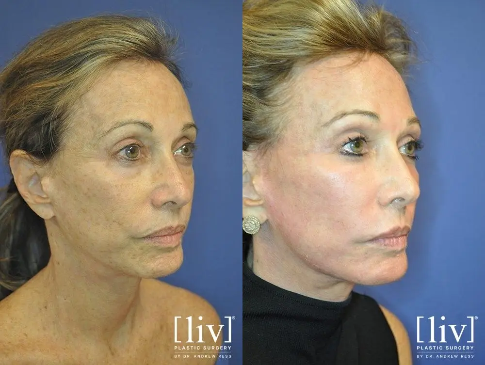 Laser Skin Resurfacing: Patient 1 - Before and After 2