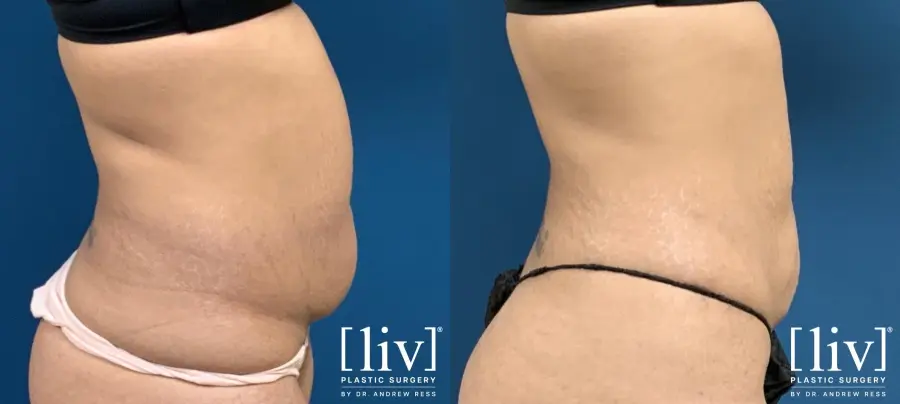 Liposuction: Patient 9 - Before and After 5