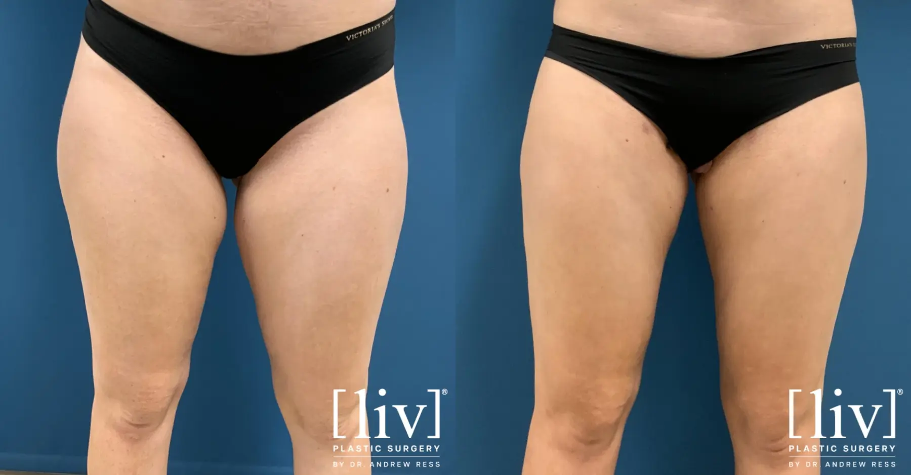 Thigh Liposuction - Before and After 3