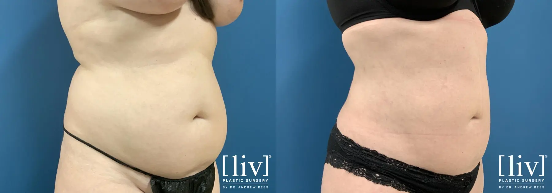 Liposuction: Patient 30 - Before and After 2