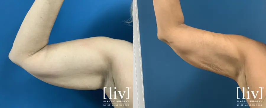 Arm Liposuction - Before and After 2