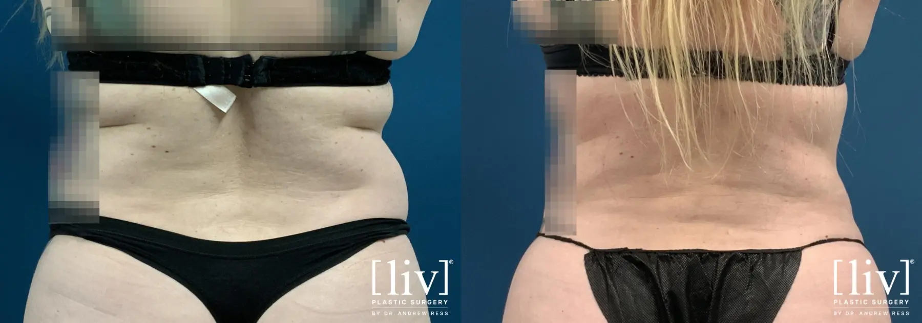 Liposuction: Patient 45 - Before and After 6