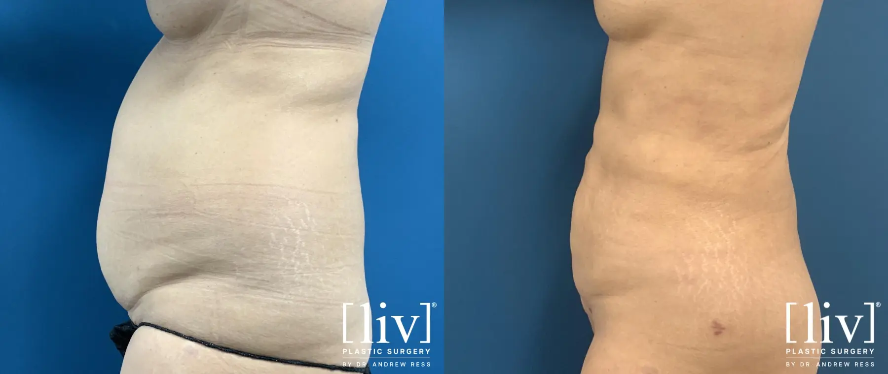 Liposuction: Patient 13 - Before and After 3