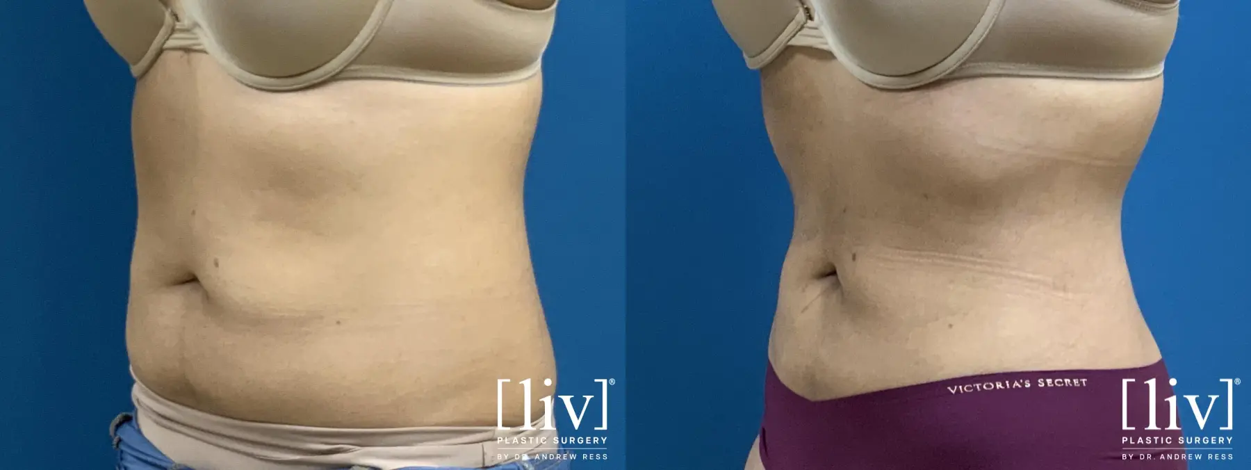 Liposuction - Before and After 2