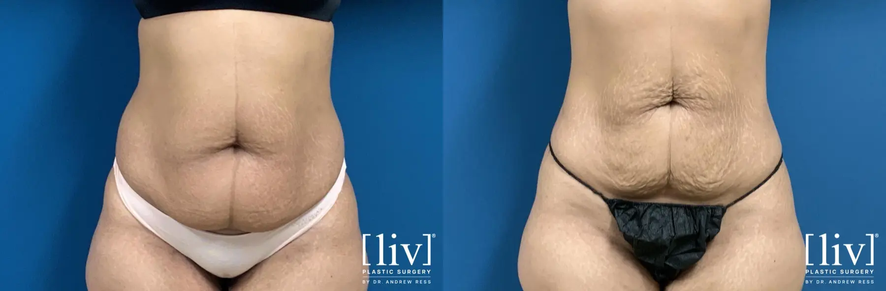 Liposuction: Patient 10 - Before and After  