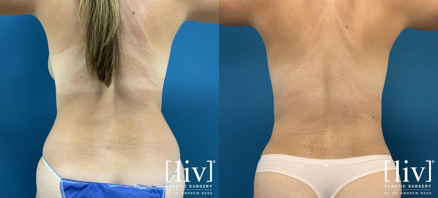 Liposuction: Patient 38 - Before and After 1