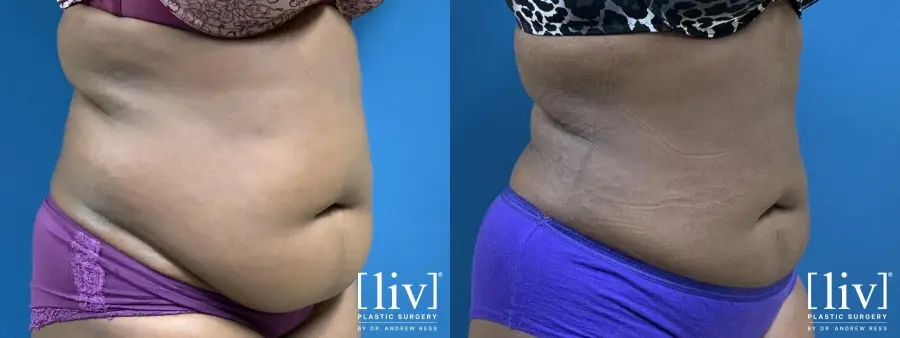 Liposuction: Patient 11 - Before and After 2