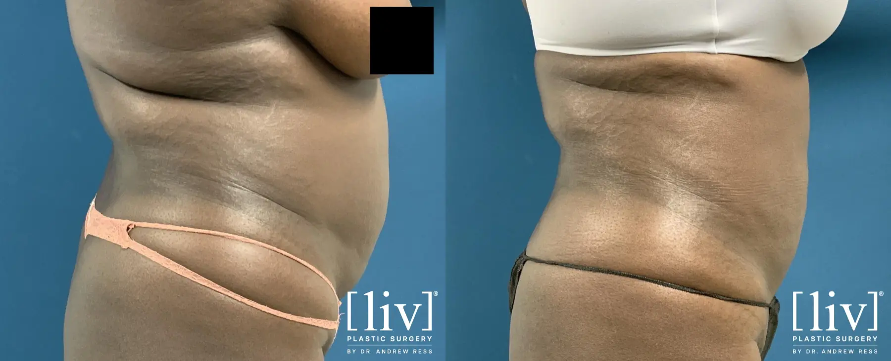 Liposuction: Patient 34 - Before and After 3