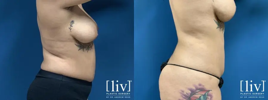 Liposuction: Patient 10 - Before and After 5