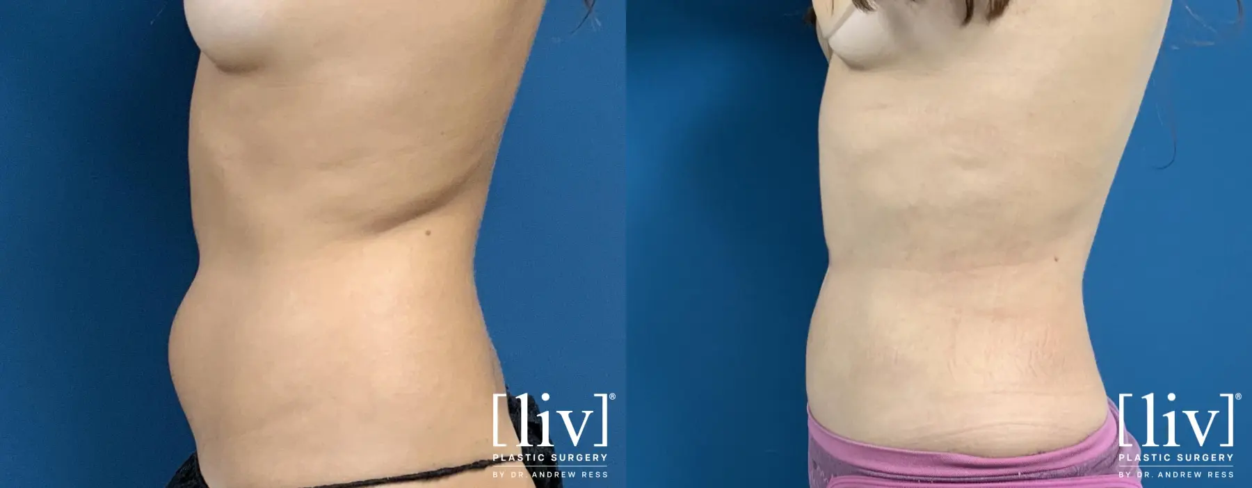 Liposuction: Patient 25 - Before and After 3