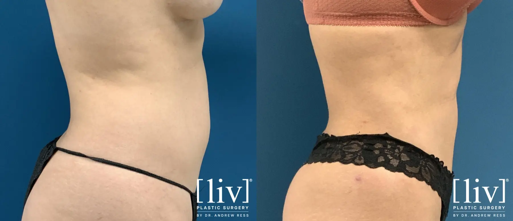 Liposuction: Patient 44 - Before and After 3