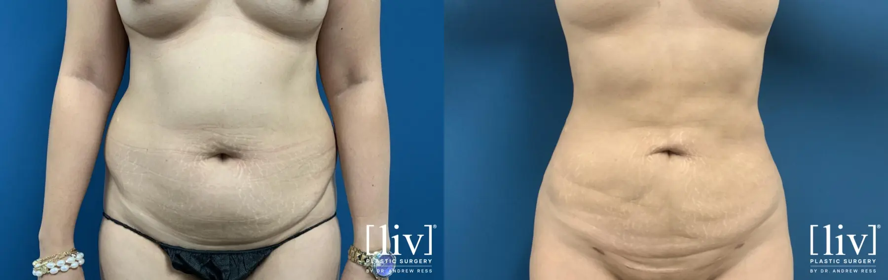 Liposuction: Patient 13 - Before and After 1