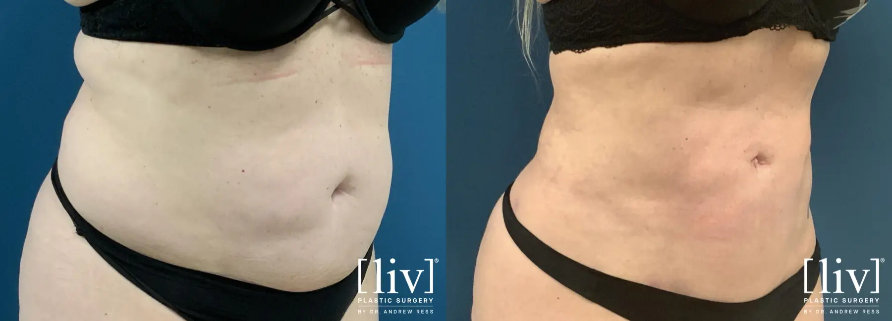 Liposuction: Patient 47 - Before and After 3