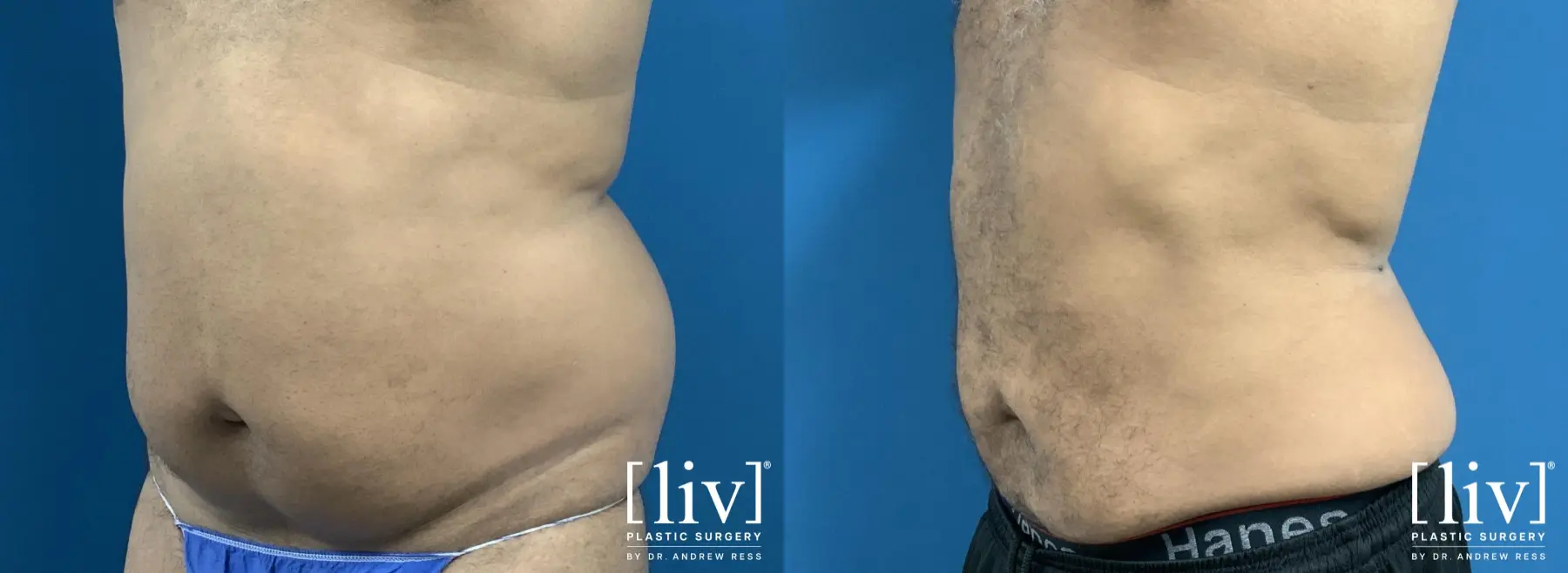 Liposuction: Patient 48 - Before and After 3