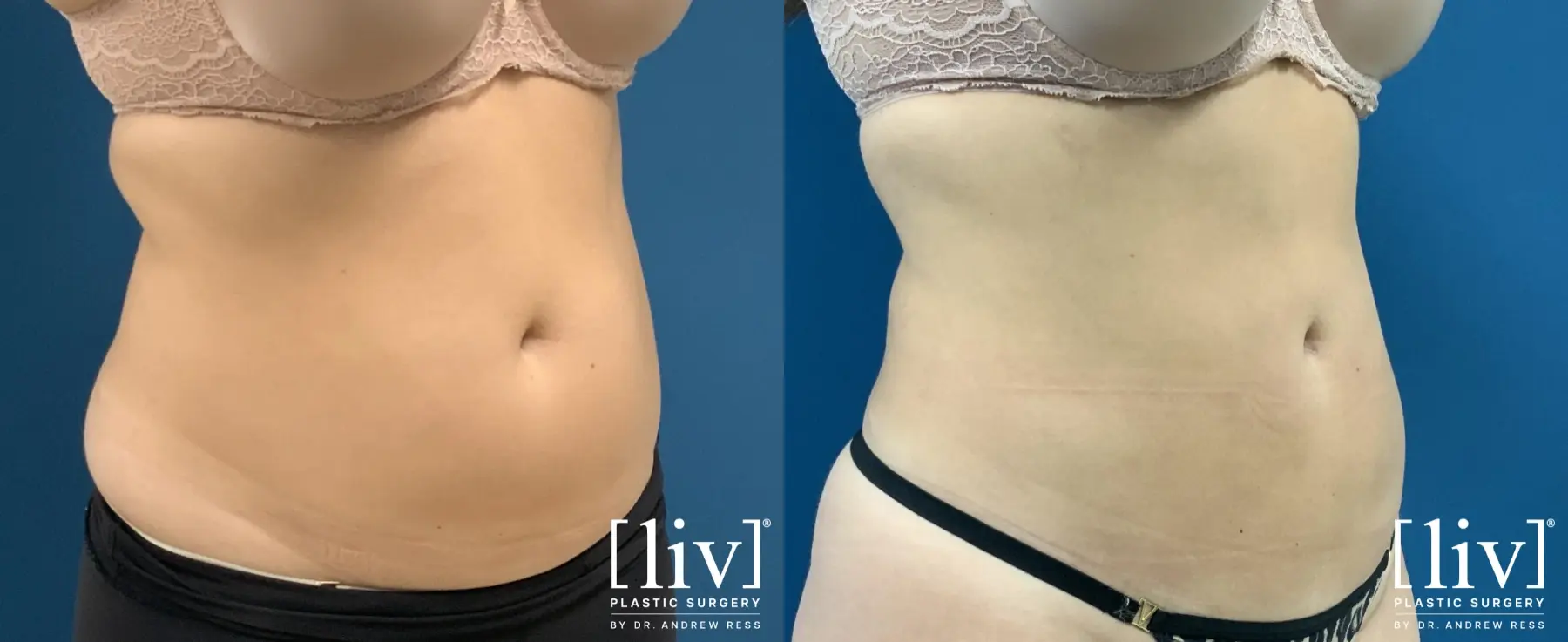 Liposuction: Patient 49 - Before and After 6