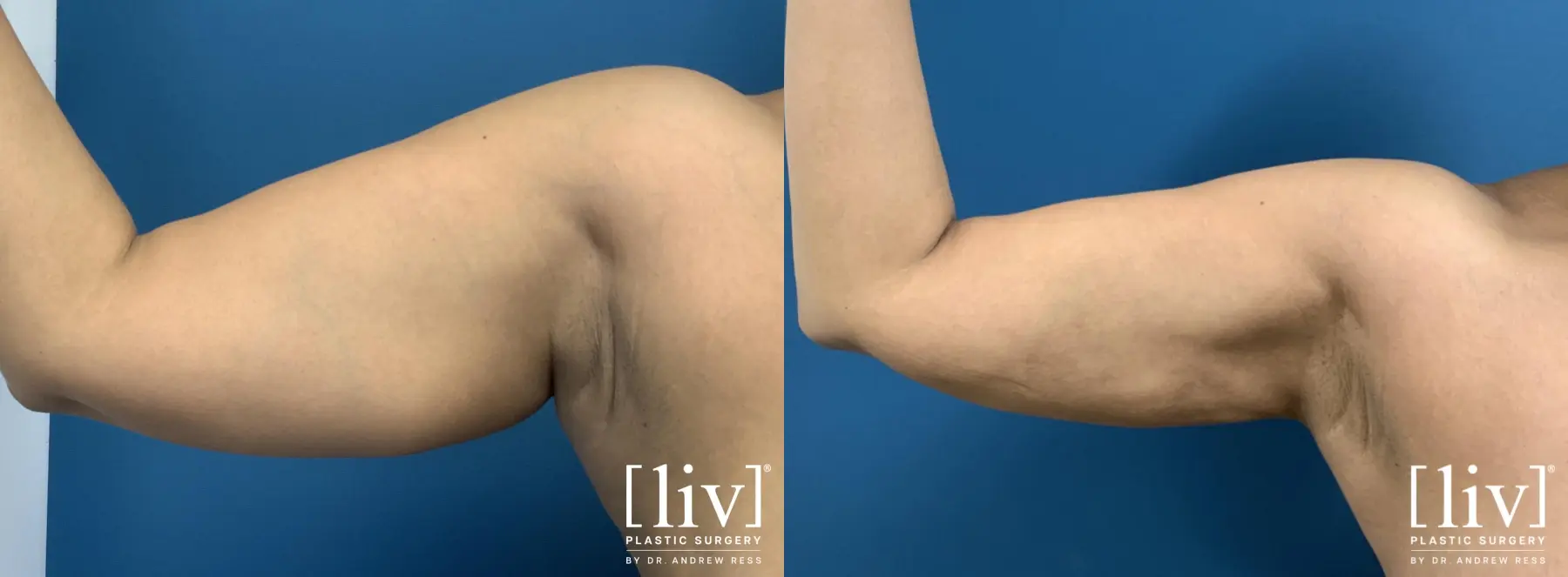 Arm Liposuction - Before and After 2