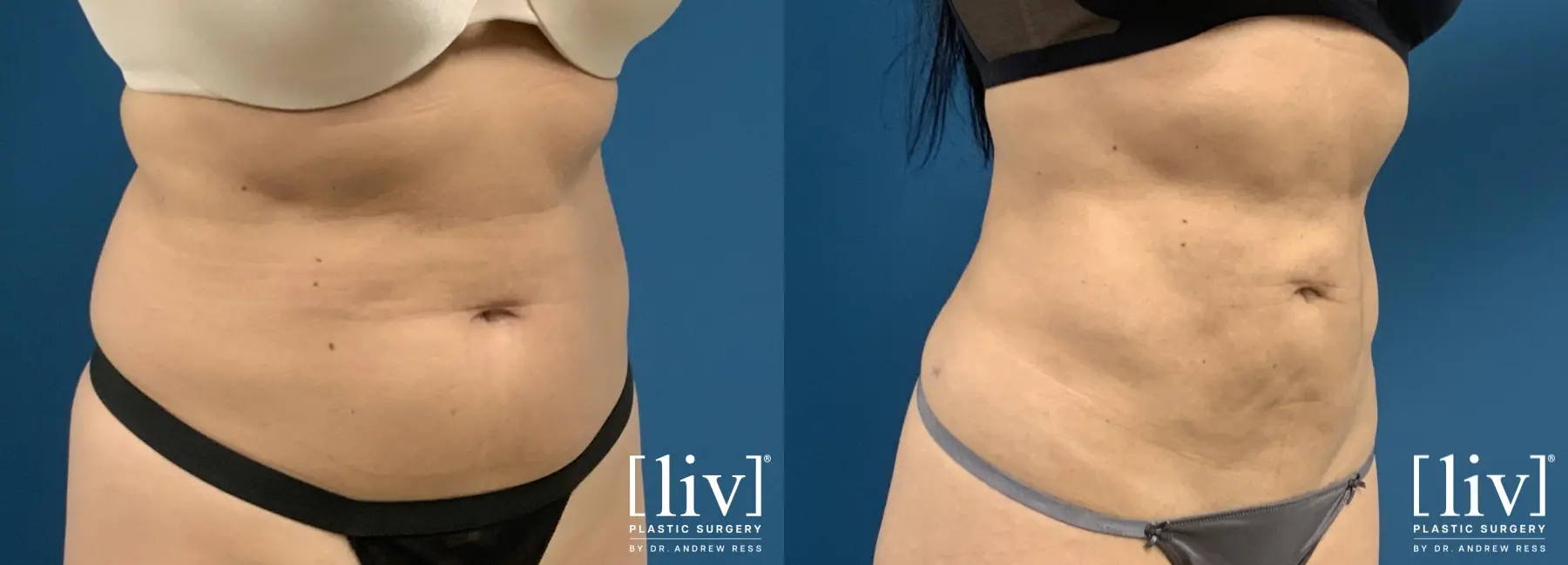 Liposuction: Patient 31 - Before and After 2
