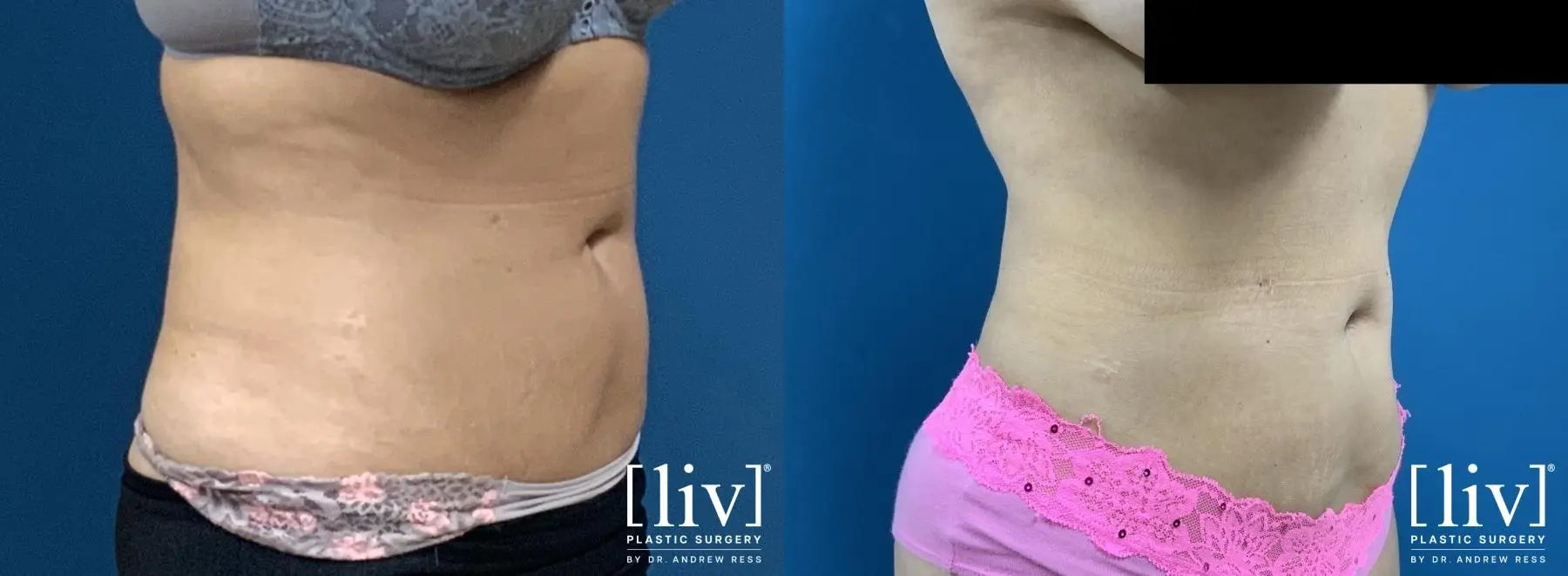 Liposuction: Patient 2 - Before and After 4