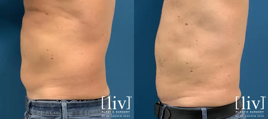 Men Liposuction - Before and After 3