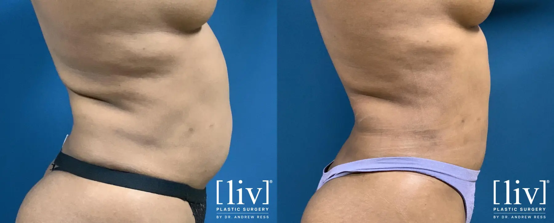 Liposuction: Patient 26 - Before and After 5