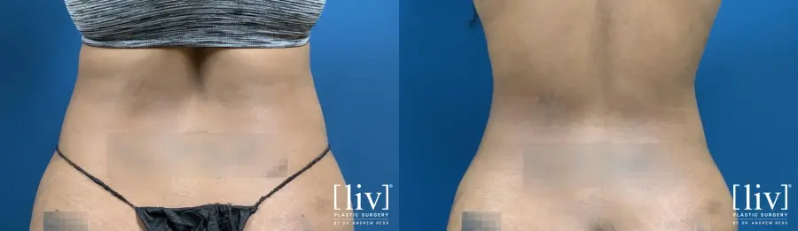Liposuction: Patient 1 - Before and After 6
