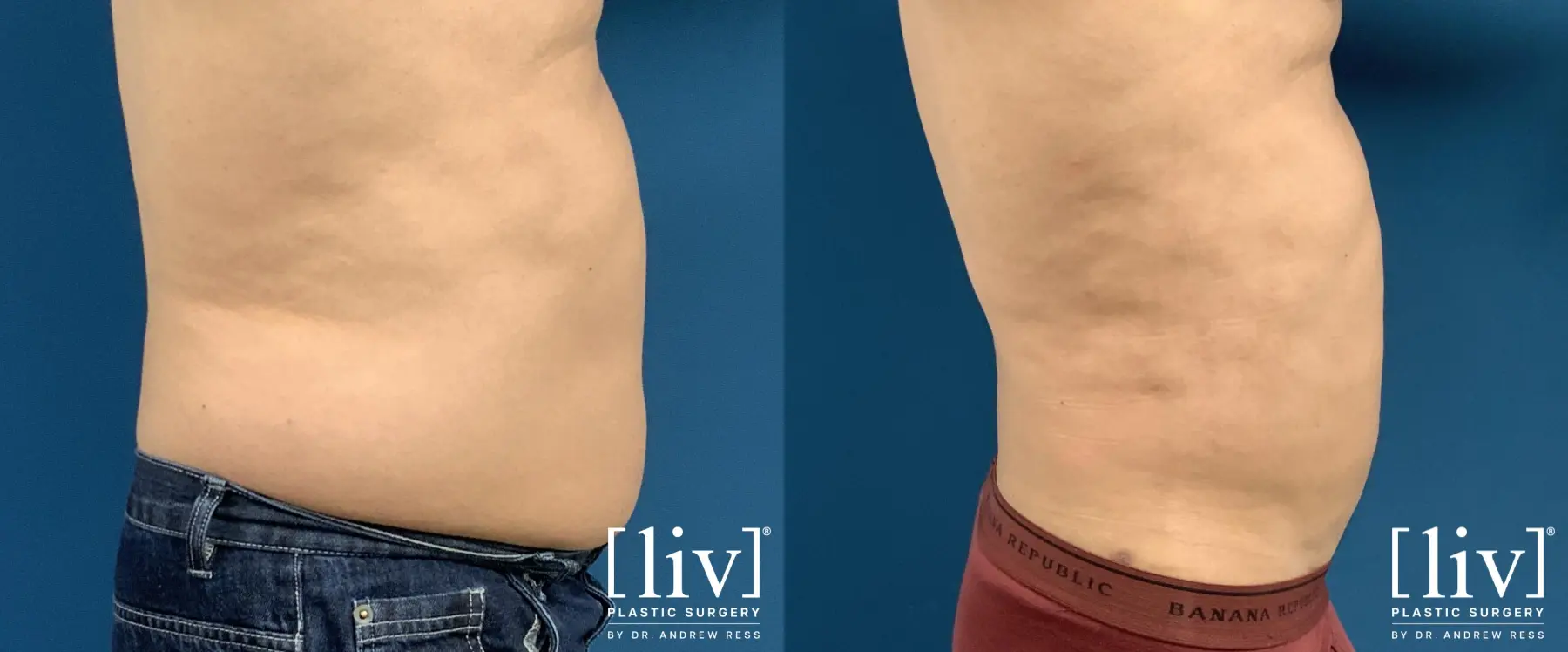 Men Liposuction - Before and After 3