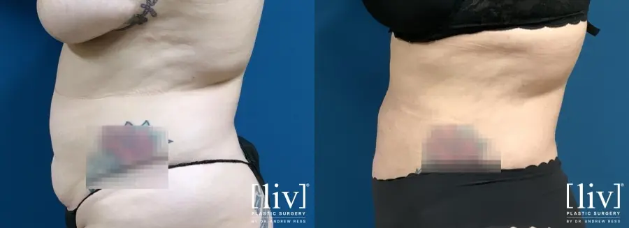 Liposuction: Patient 9 - Before and After 5