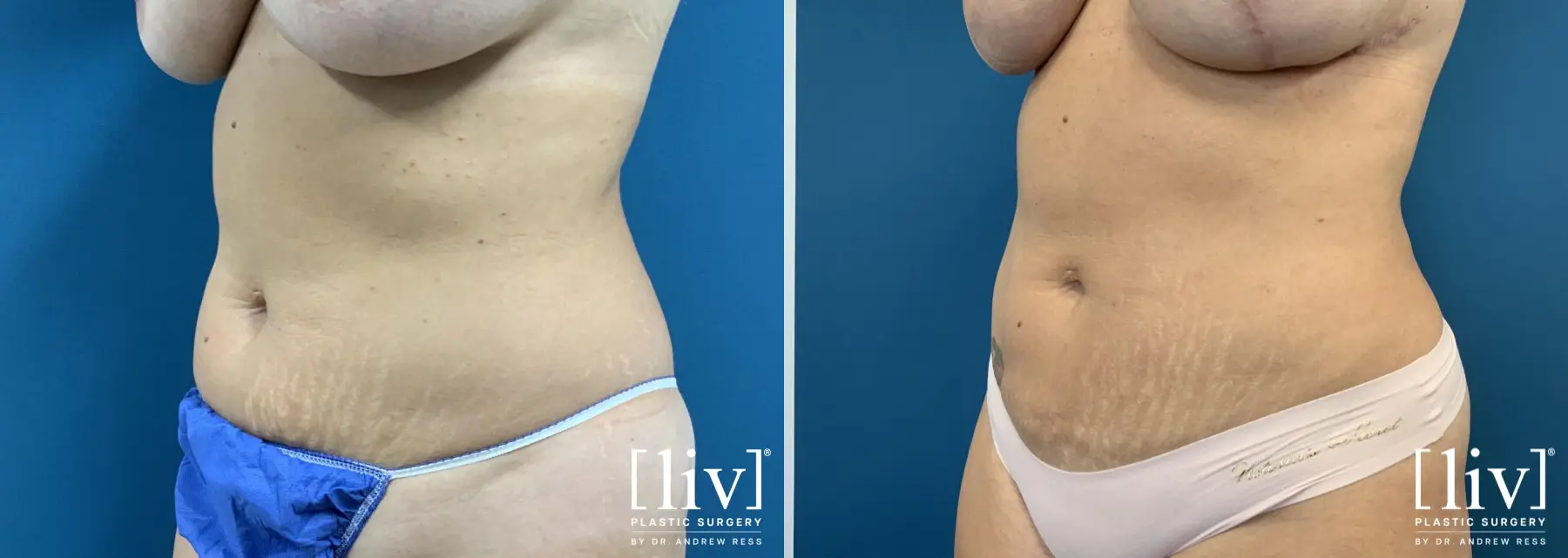 Liposuction: Patient 38 - Before and After 3