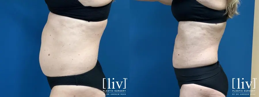 Liposuction: Patient 6 - Before and After 3