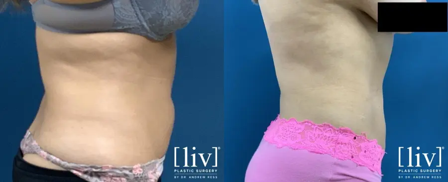 Liposuction: Patient 2 - Before and After 5