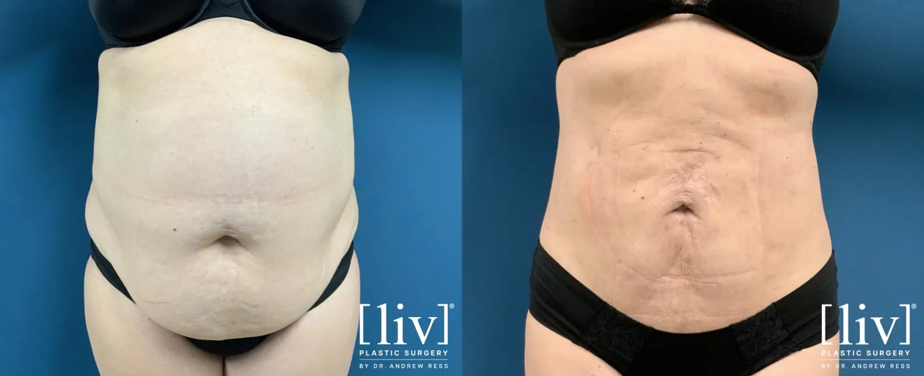 Liposuction: Patient 35 - Before and After 1