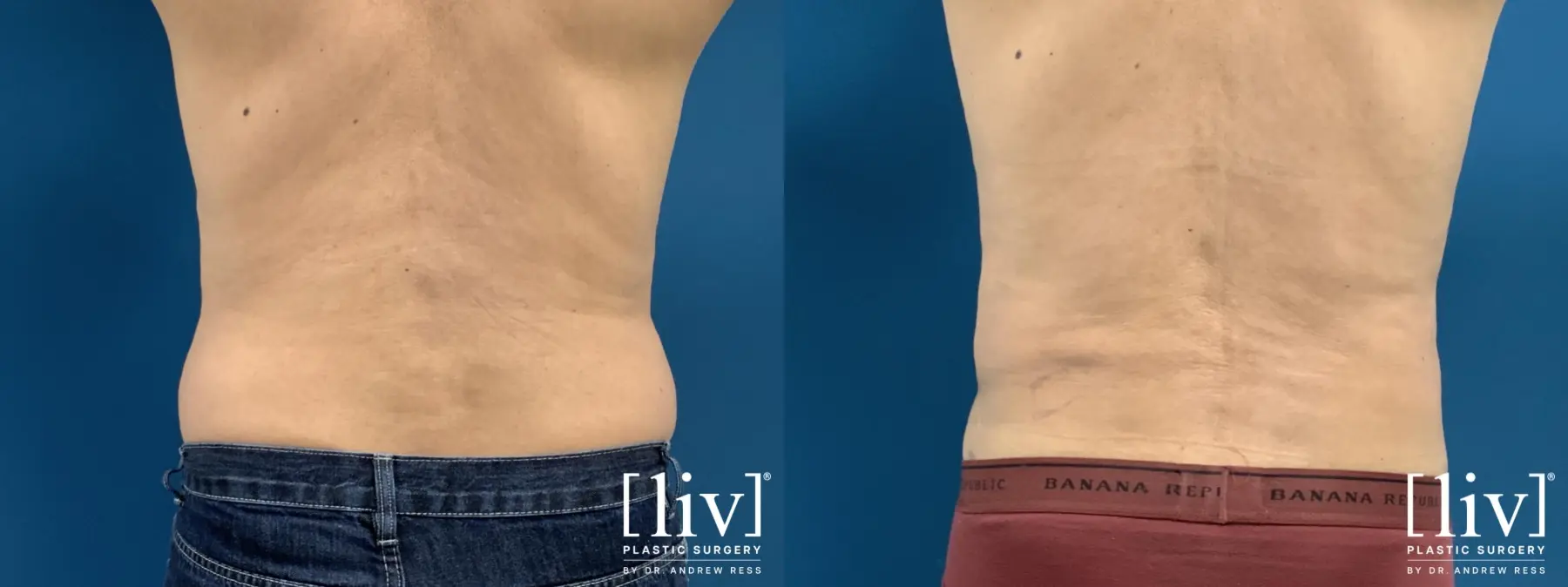 Men Liposuction - Before and After 4