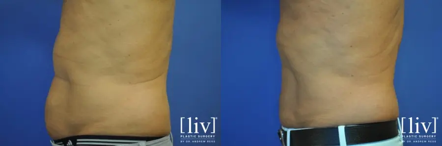 Liposuction: Patient 2 - Before and After 3