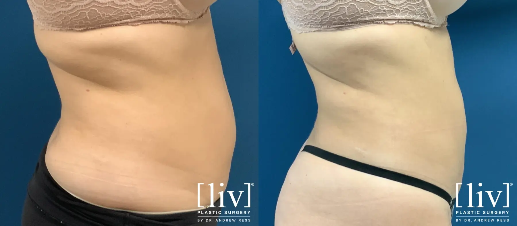 Liposuction: Patient 49 - Before and After 5
