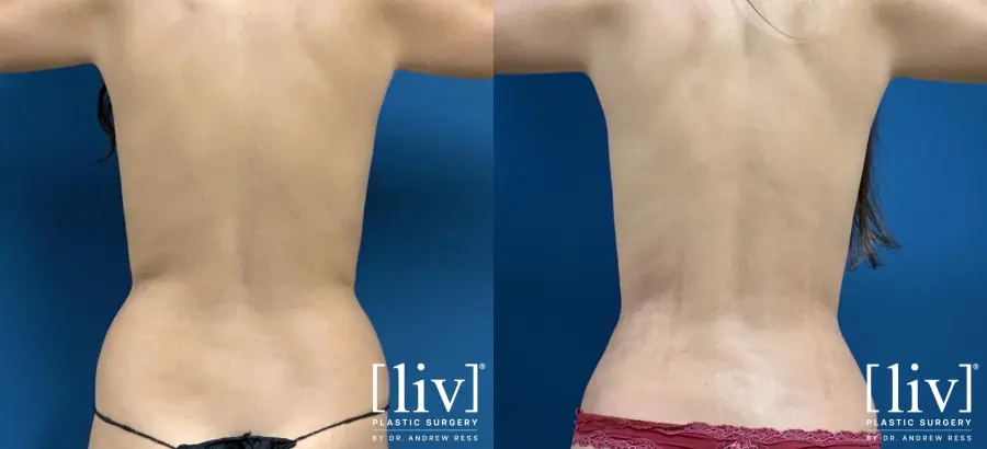Liposuction: Patient 23 - Before and After 6