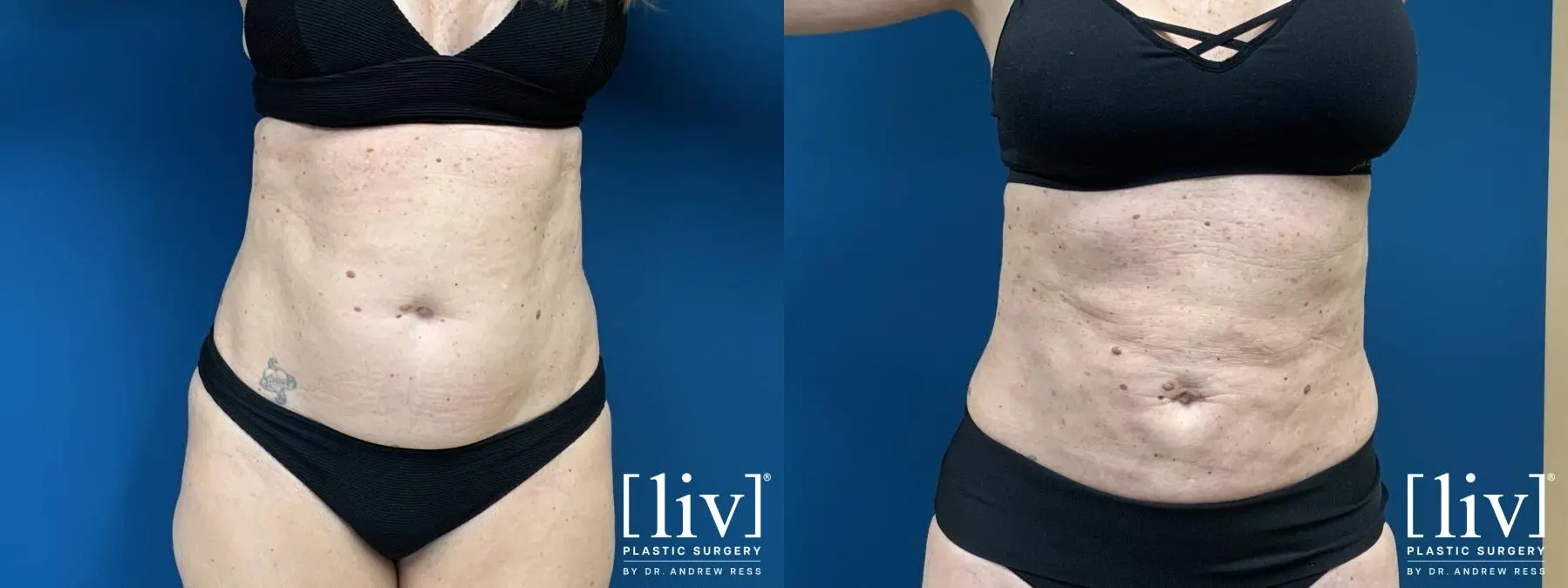 Liposuction: Patient 6 - Before and After 5