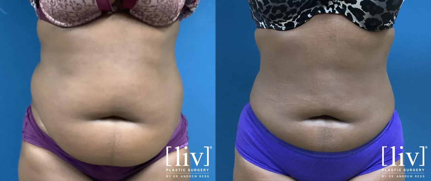 Liposuction: Patient 12 - Before and After 1