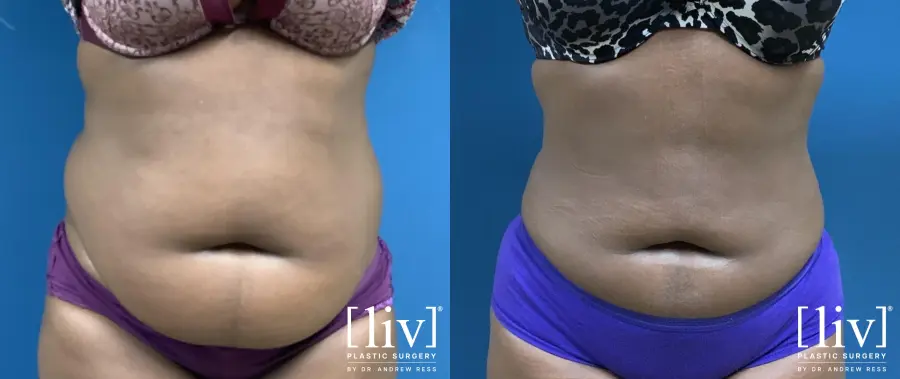 Liposuction: Patient 7 - Before and After  