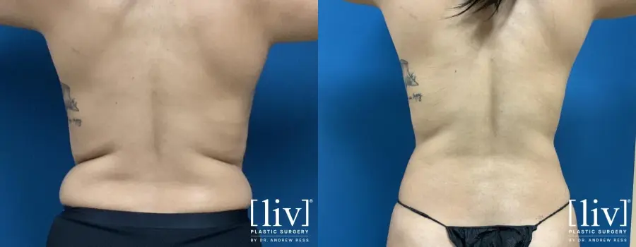 Liposuction: Patient 10 - Before and After 6