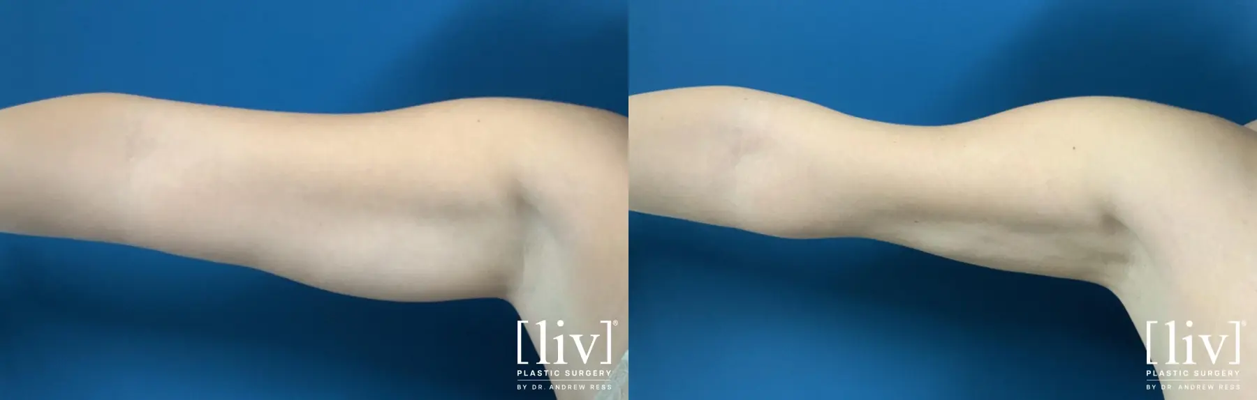 Arm Liposuction - Before and After 2