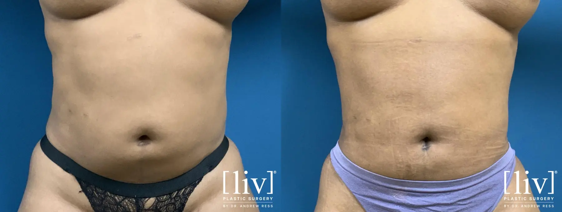 Liposuction: Patient 26 - Before and After 1